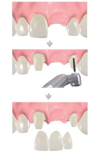 �]���̎��Á@�u���b�W�E�`��