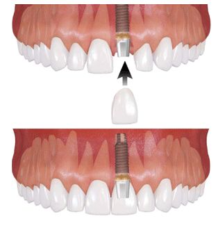 �C���v�����g���×�1-b