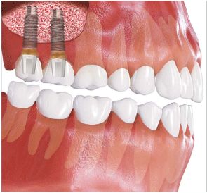 �T�C�i�X���t�g